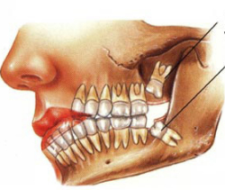 Зуб мудрости
